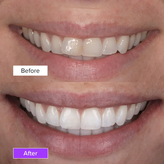 Teeth Whitening Before and After