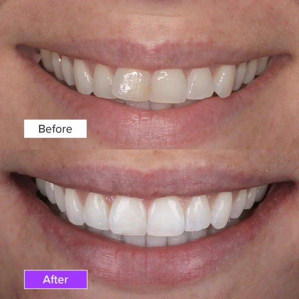 Teeth Whitening Before and After
