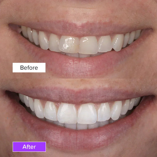 Teeth Whitening Before and After
