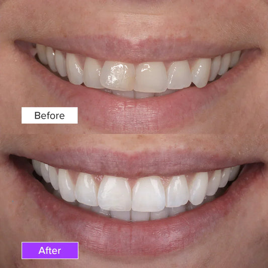 Teeth Whitening Before and After