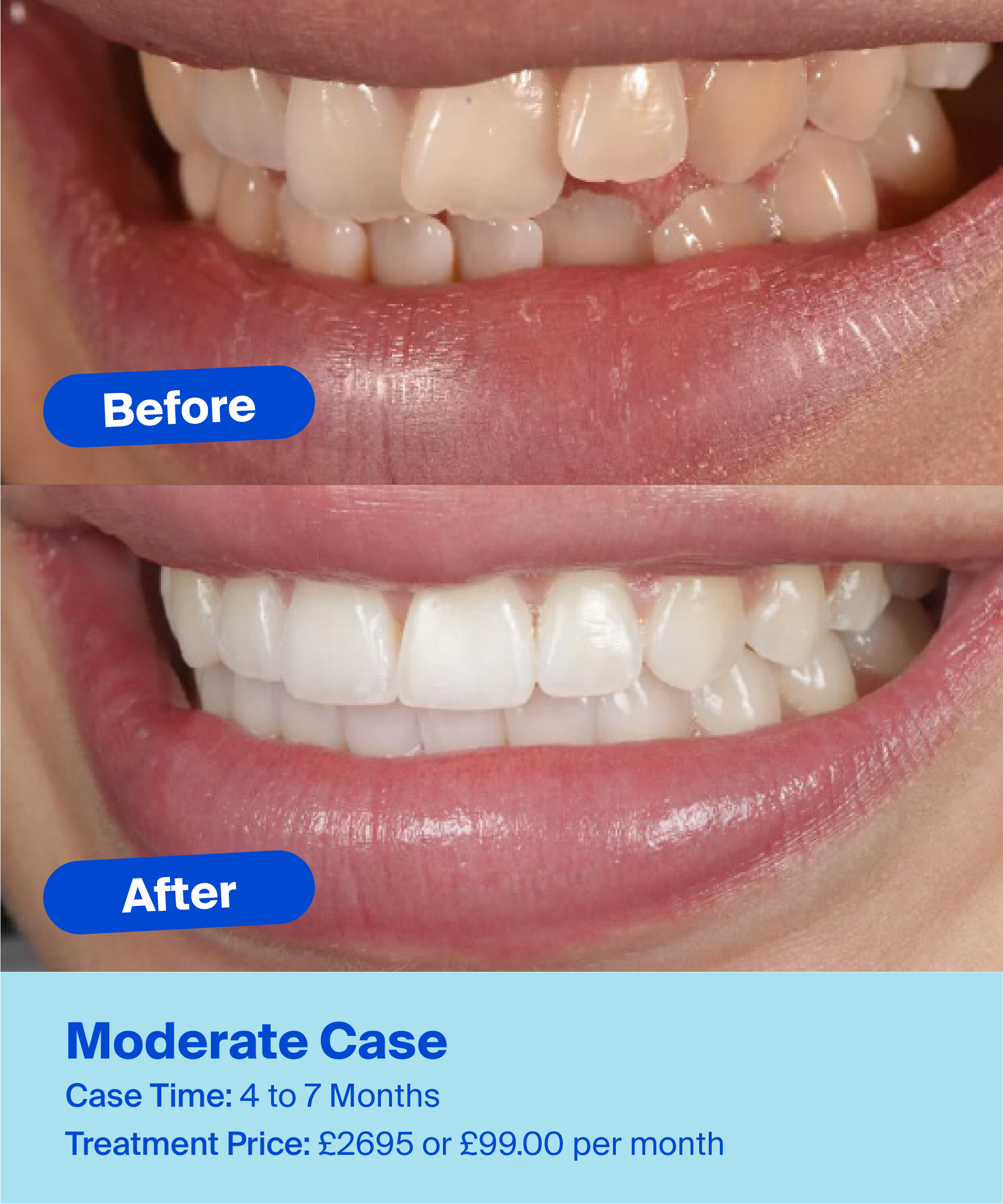 Clear Aligners