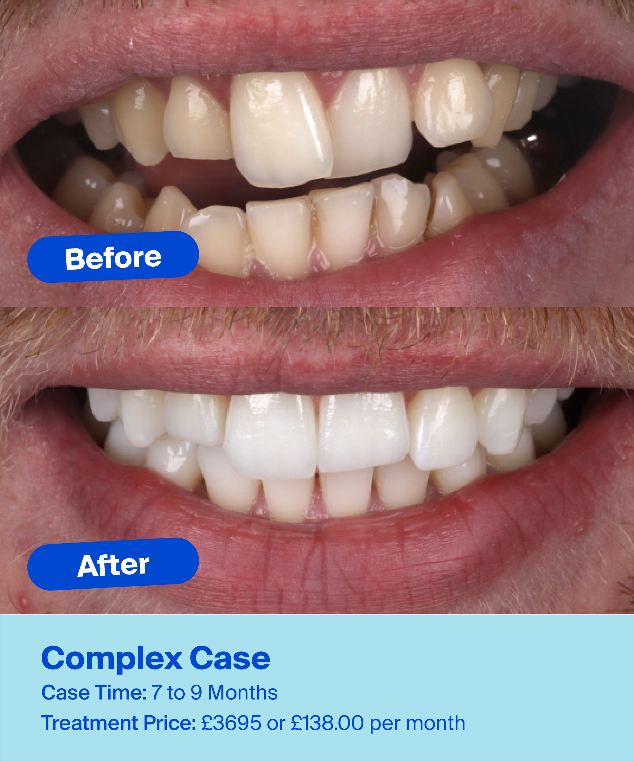 Clear Aligners