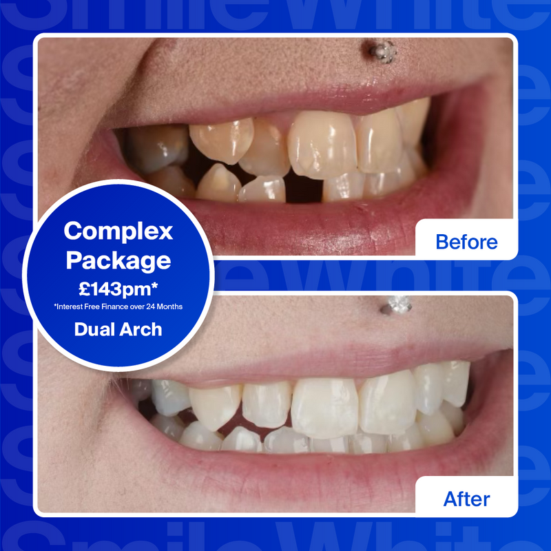 Clear Aligners - Single Arch (top or bottom teeth)/Mild