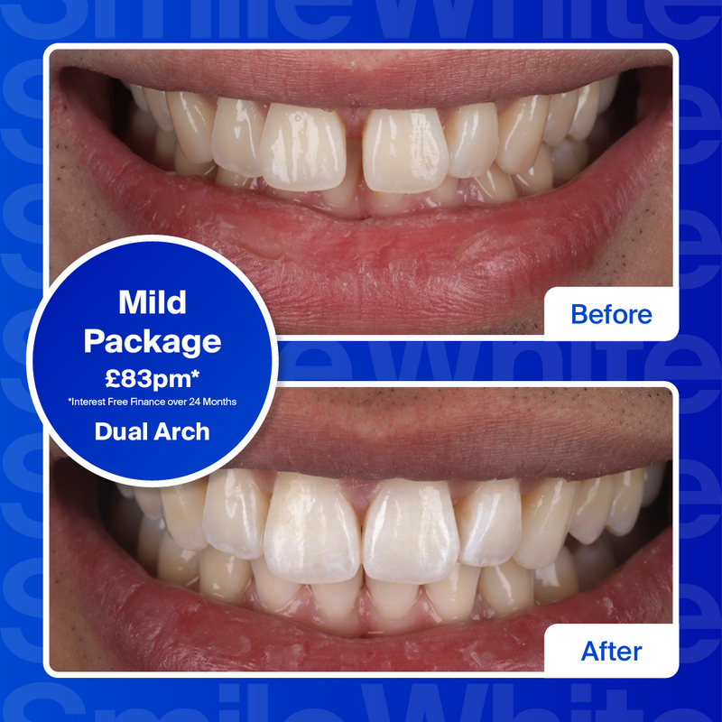 Clear Aligners - Single Arch (top or bottom teeth)/Mild