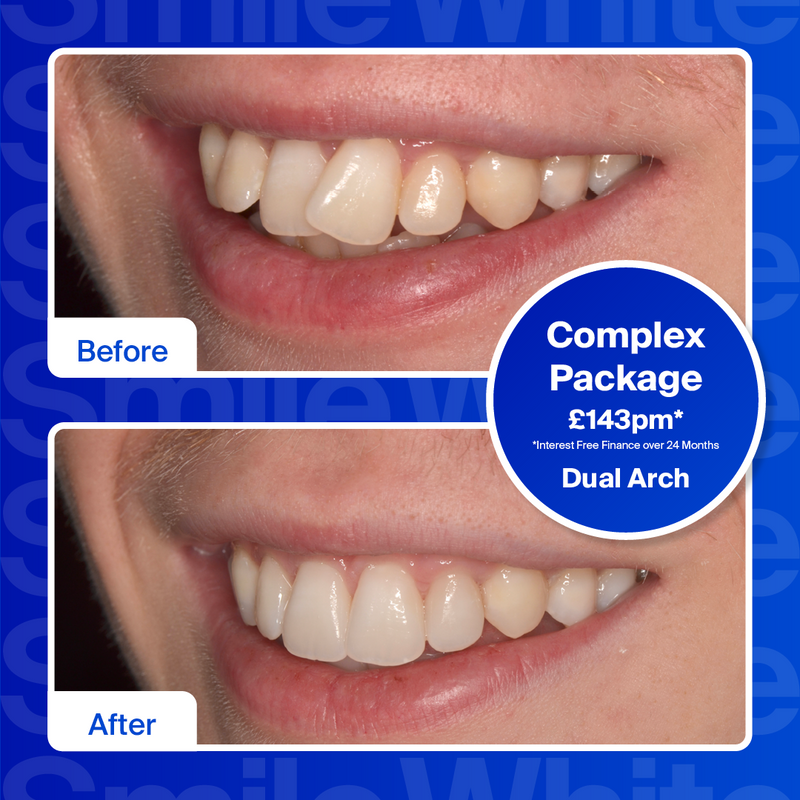 Clear Aligners - Dual Arch (top or bottom teeth)/Moderate