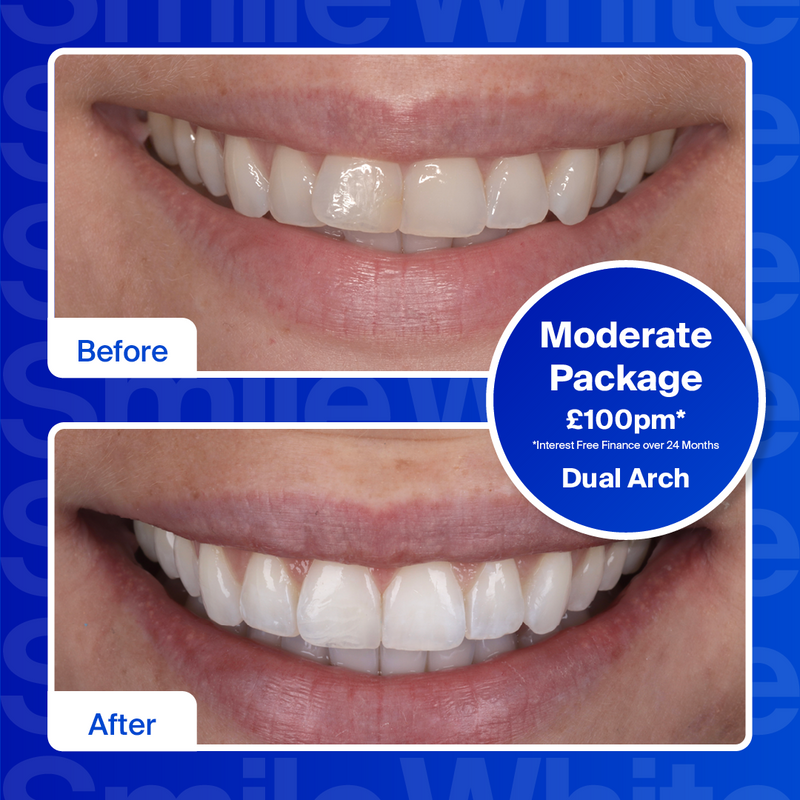 Clear Aligners - Single Arch (top or bottom teeth)/Mild