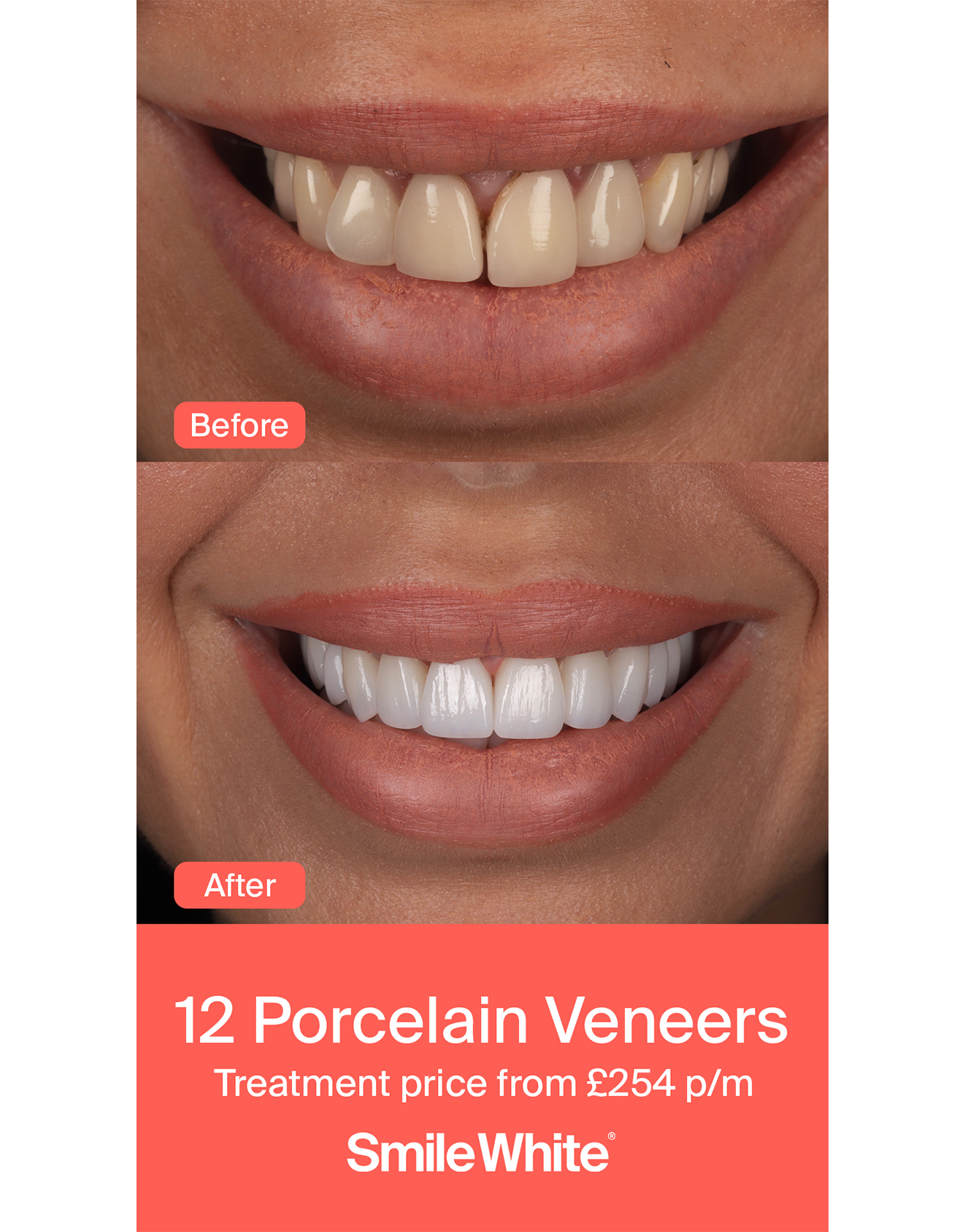 Veneers & Crowns