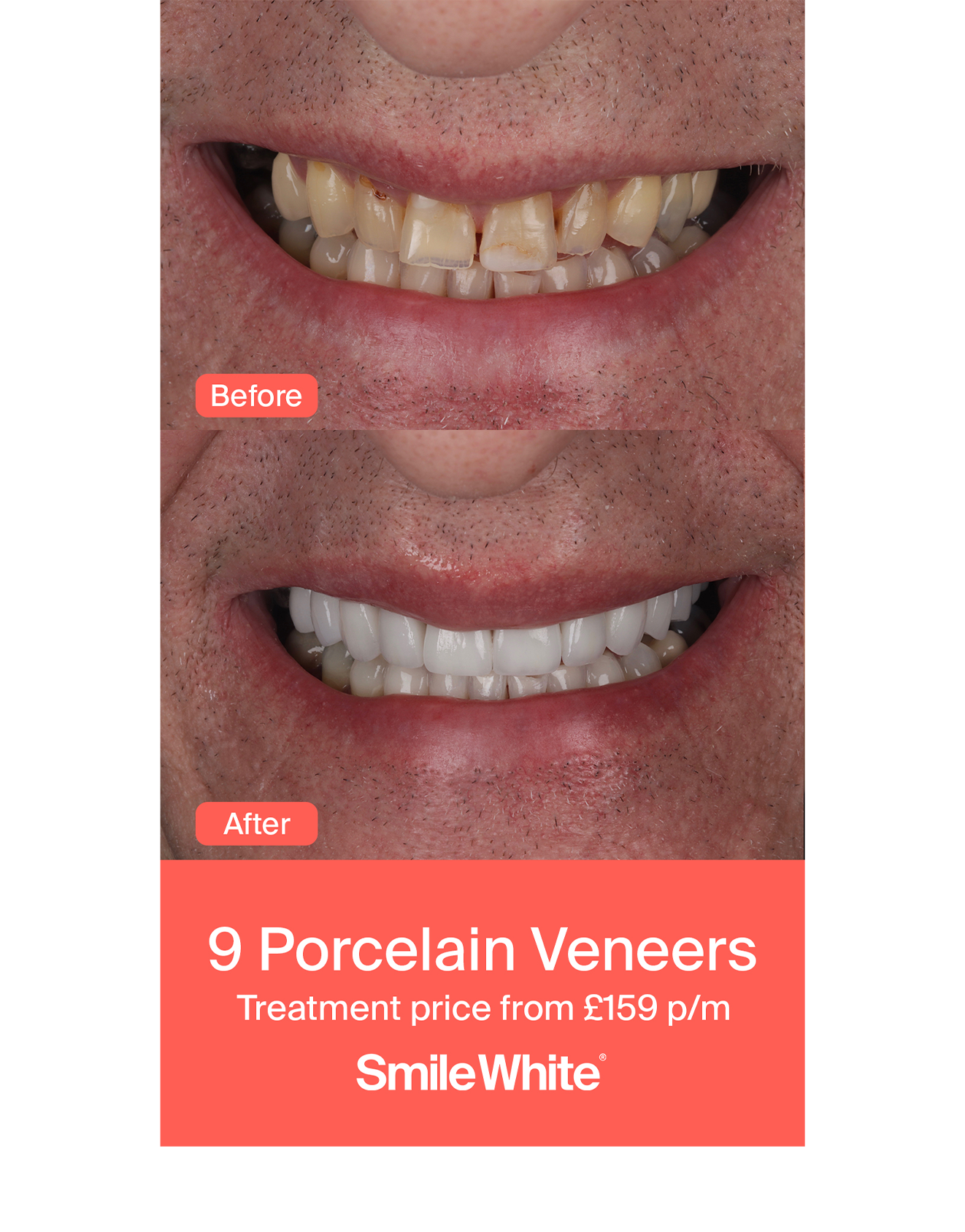 Veneers & Crowns